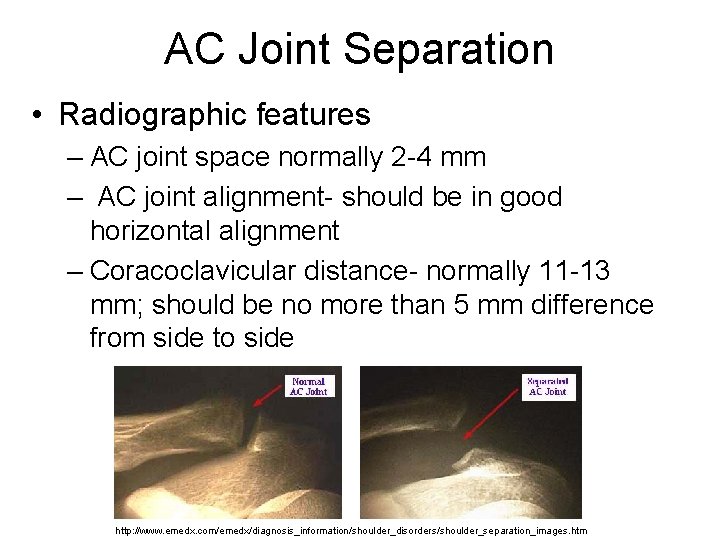 AC Joint Separation • Radiographic features – AC joint space normally 2 -4 mm