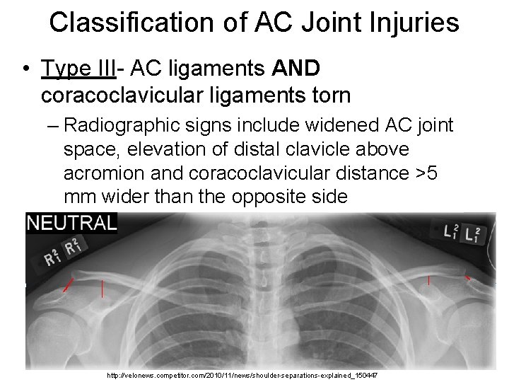 Classification of AC Joint Injuries • Type III- AC ligaments AND coracoclavicular ligaments torn