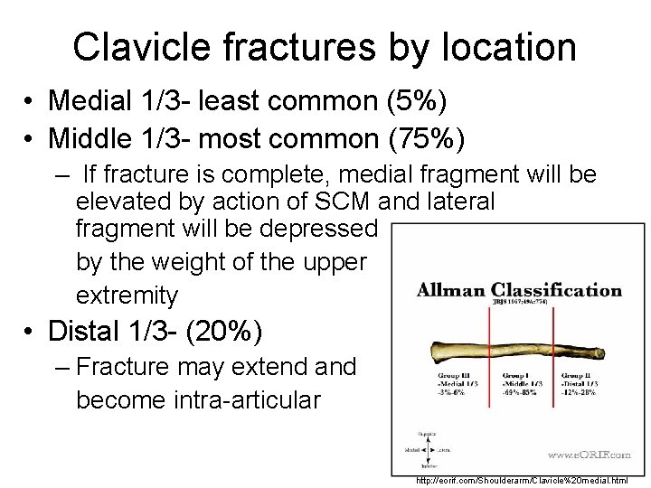 Clavicle fractures by location • Medial 1/3 - least common (5%) • Middle 1/3