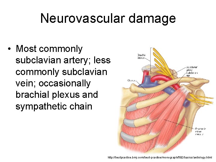 Neurovascular damage • Most commonly subclavian artery; less commonly subclavian vein; occasionally brachial plexus