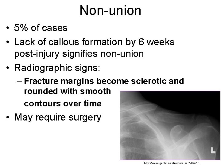 Non-union • 5% of cases • Lack of callous formation by 6 weeks post-injury
