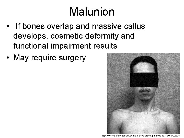Malunion • If bones overlap and massive callus develops, cosmetic deformity and functional impairment