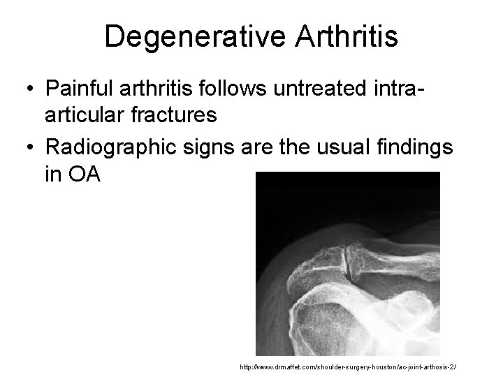 Degenerative Arthritis • Painful arthritis follows untreated intraarticular fractures • Radiographic signs are the