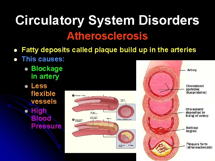 Circulatory System Disorders Atherosclerosis l l Fatty deposits called plaque build up in the