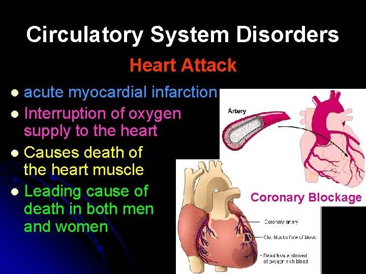 Circulatory System Disorders Heart Attack acute myocardial infarction l Interruption of oxygen supply to