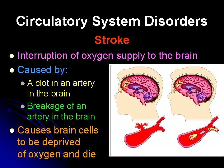 Circulatory System Disorders Stroke Interruption of oxygen supply to the brain l Caused by: