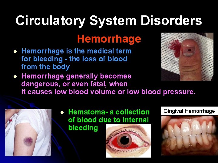 Circulatory System Disorders Hemorrhage l l Hemorrhage is the medical term for bleeding -