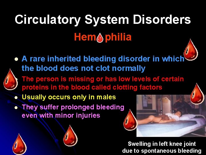Circulatory System Disorders Hem philia l A rare inherited bleeding disorder in which the