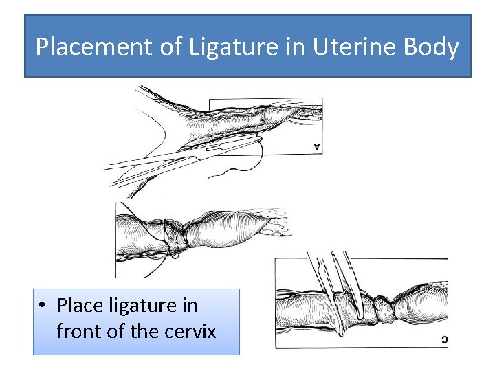 Placement of Ligature in Uterine Body • Place ligature in front of the cervix