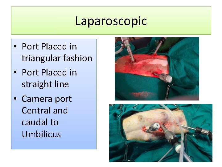 Laparoscopic • Port Placed in triangular fashion • Port Placed in straight line •