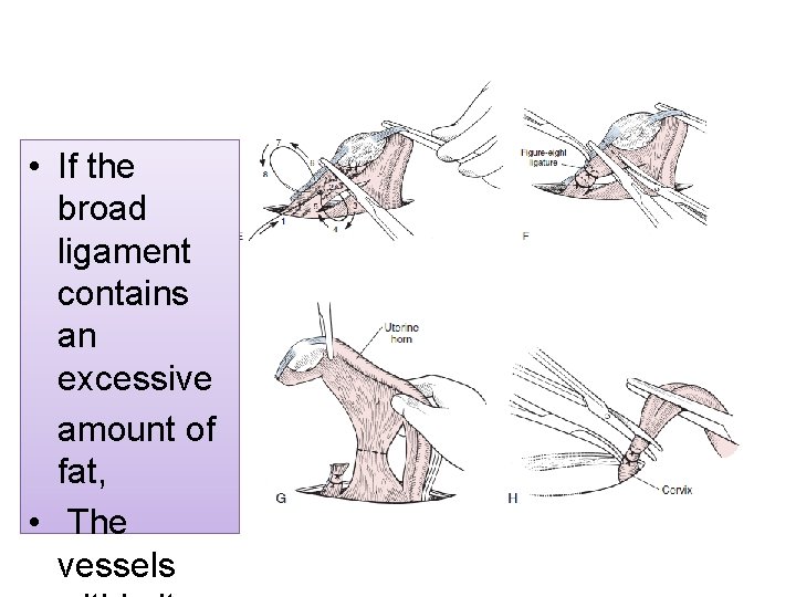  • If the broad ligament contains an excessive amount of fat, • The