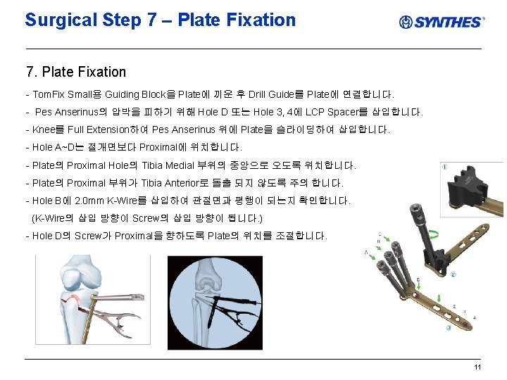 Surgical Step 7 – Plate Fixation 7. Plate Fixation - Tom. Fix Small용 Guiding