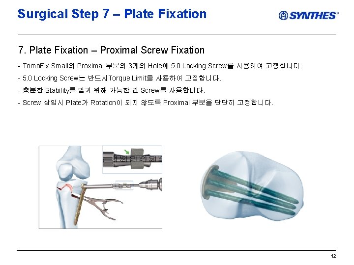 Surgical Step 7 – Plate Fixation 7. Plate Fixation – Proximal Screw Fixation -