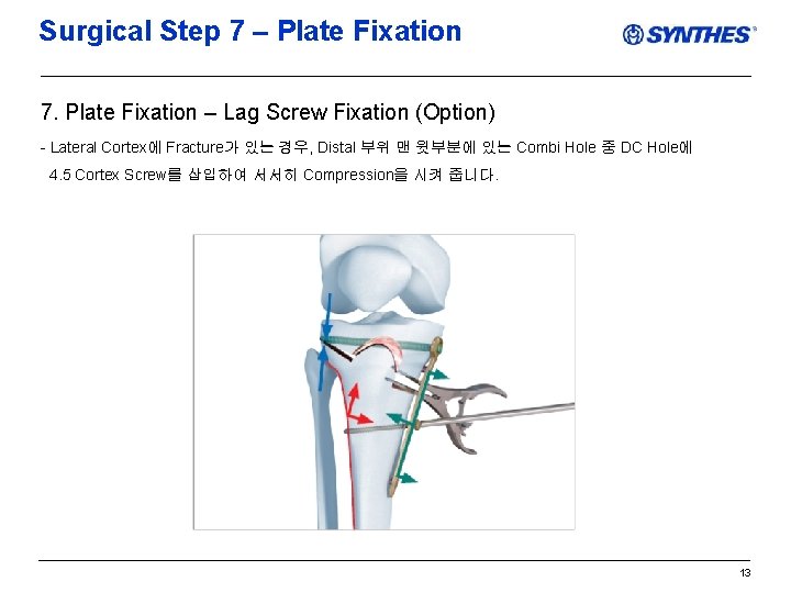 Surgical Step 7 – Plate Fixation 7. Plate Fixation – Lag Screw Fixation (Option)