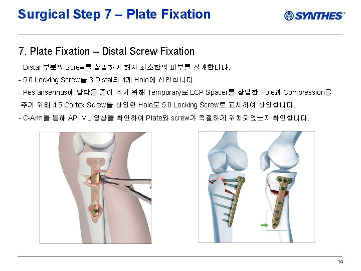 Surgical Step 7 – Plate Fixation 7. Plate Fixation – Distal Screw Fixation -