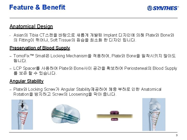 Feature & Benefit Anatomical Design - Asian의 Tibia CT스캔을 바탕으로 새롭게 개발된 Implant 디자인에