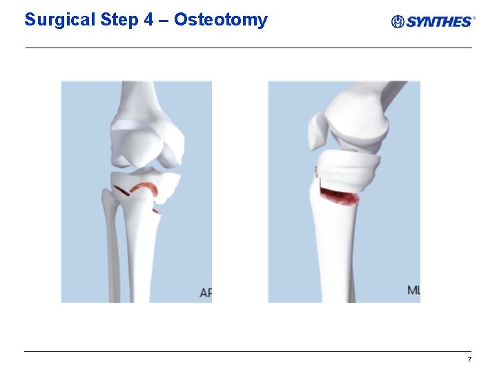Surgical Step 4 – Osteotomy 7 