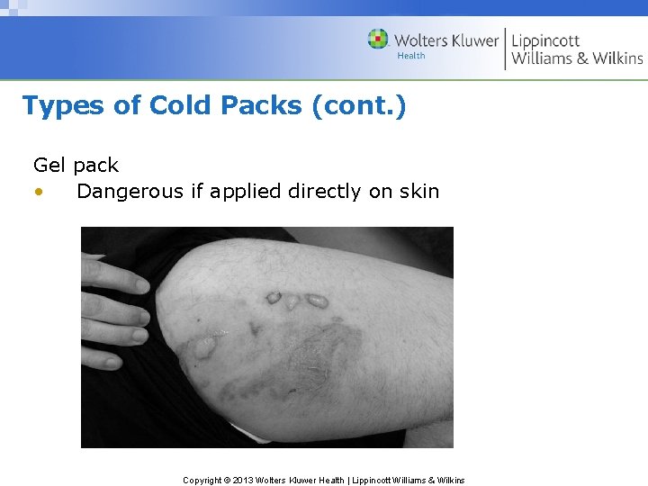 Types of Cold Packs (cont. ) Gel pack • Dangerous if applied directly on