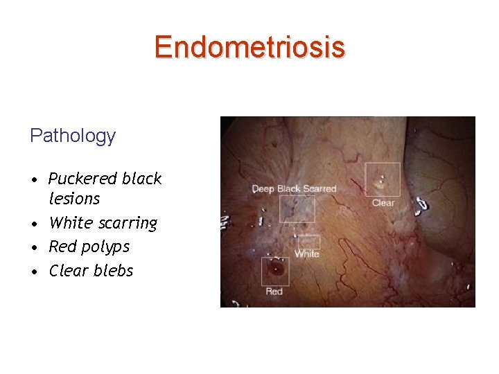 Endometriosis Pathology • Puckered black lesions • White scarring • Red polyps • Clear