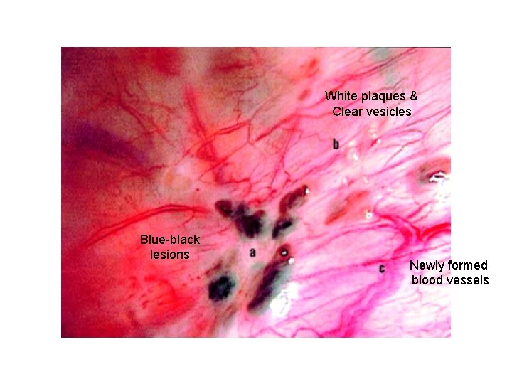 White plaques & Clear vesicles Blue-black lesions Newly formed blood vessels 