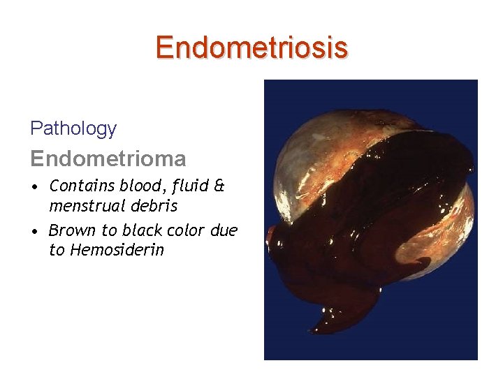 Endometriosis Pathology Endometrioma • Contains blood, fluid & menstrual debris • Brown to black