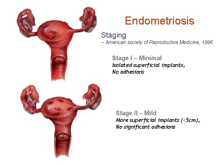 Endometriosis Staging – American society of Reproductive Medicine, 1996 Stage I – Minimal Isolated