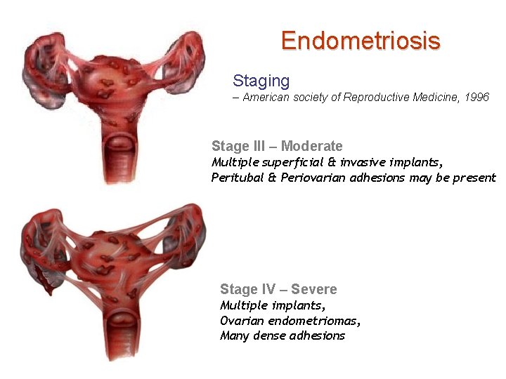 Endometriosis Staging – American society of Reproductive Medicine, 1996 Stage III – Moderate Multiple