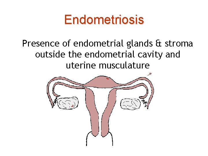 Endometriosis Presence of endometrial glands & stroma outside the endometrial cavity and uterine musculature