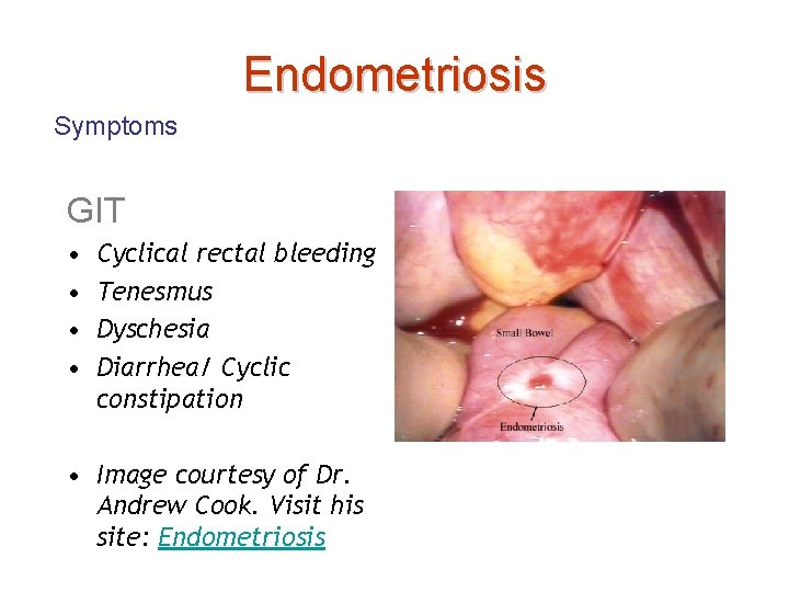 Endometriosis Symptoms GIT • • Cyclical rectal bleeding Tenesmus Dyschesia Diarrhea/ Cyclic constipation •