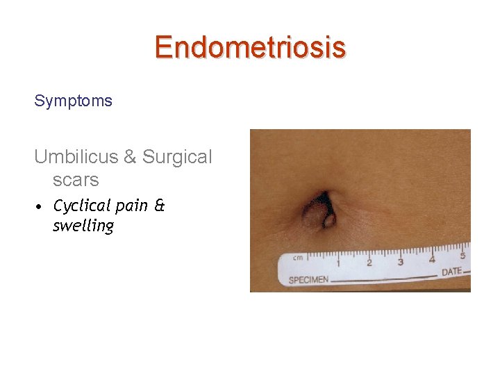 Endometriosis Symptoms Umbilicus & Surgical scars • Cyclical pain & swelling 