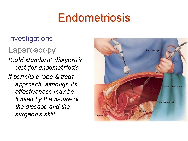 Endometriosis Investigations Laparoscopy ‘Gold standard’ diagnostic test for endometriosis It permits a “see &