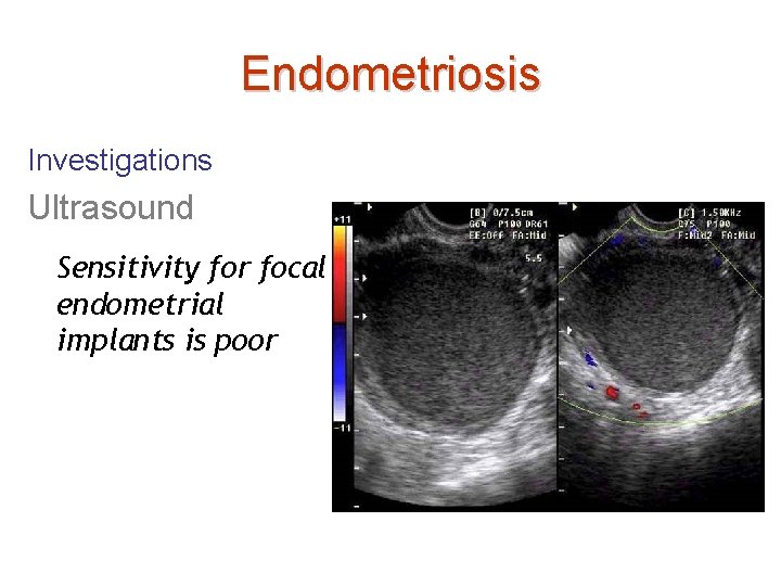 Endometriosis Investigations Ultrasound Sensitivity for focal endometrial implants is poor 