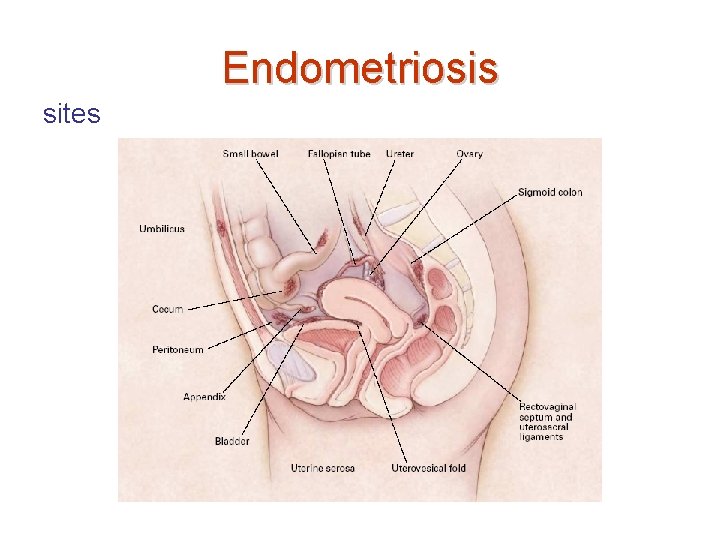 Endometriosis sites 