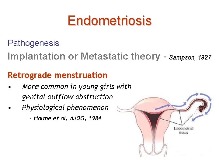 Endometriosis Pathogenesis Implantation or Metastatic theory - Sampson, 1927 Retrograde menstruation • • More