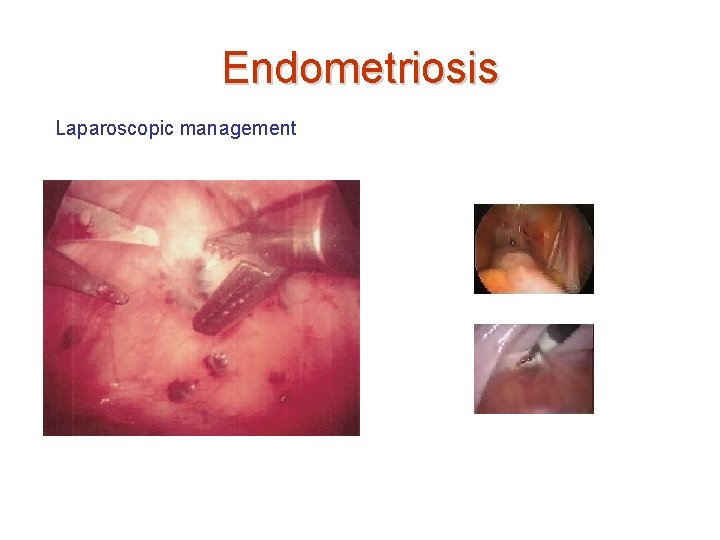 Endometriosis Laparoscopic management 