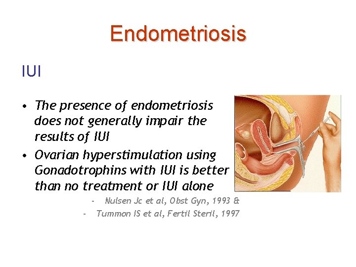 Endometriosis IUI • The presence of endometriosis does not generally impair the results of
