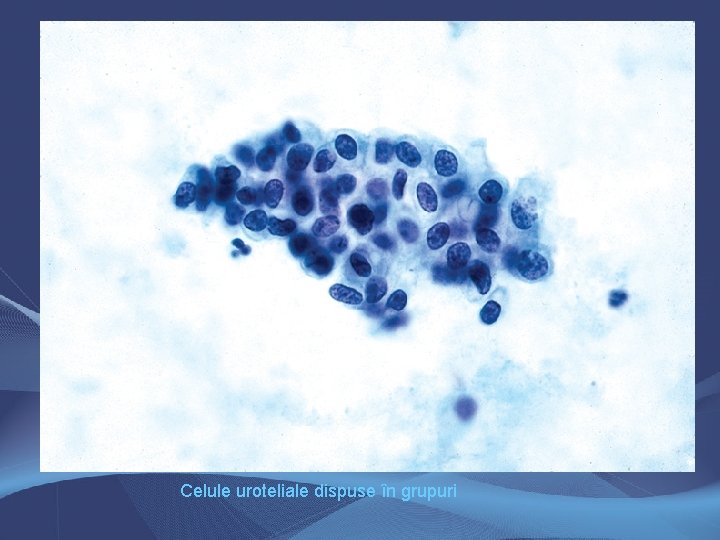 Celule uroteliale dispuse în grupuri Celule uroteliale dispuse în grupuri