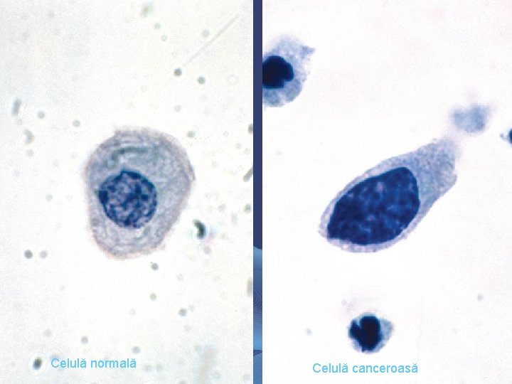 Celulă normală Celulă canceroasă Celulă normală Celulă canceroasă
