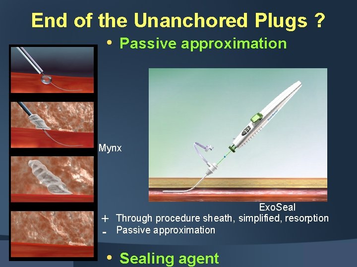 End of the Unanchored Plugs ? • Passive approximation Mynx - Exo. Seal Through