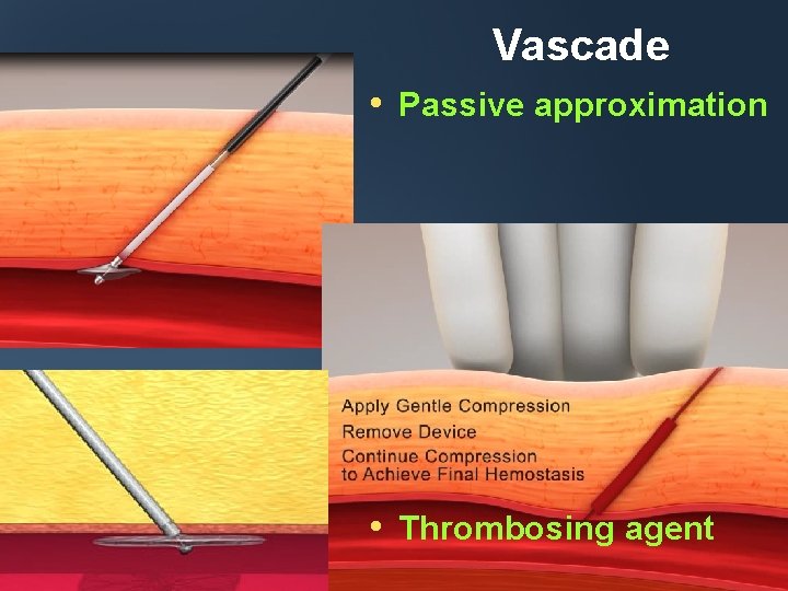 Vascade • Passive approximation • Thrombosing agent 