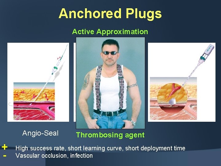 Anchored Plugs Active Approximation Angio-Seal - Thrombosing agent High success rate, short learning curve,