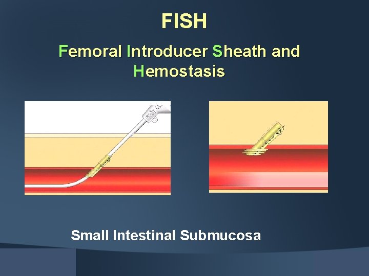 FISH Femoral Introducer Sheath and Hemostasis Small Intestinal Submucosa 