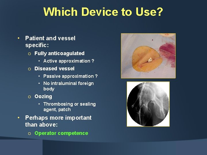 Which Device to Use? • Patient and vessel specific: ¡ Fully anticoagulated • Active