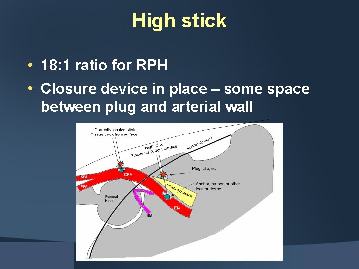 High stick • 18: 1 ratio for RPH • Closure device in place –