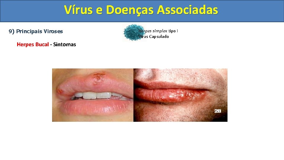 Vírus e Doenças Associadas 9) Principais Viroses Herpes Bucal - Sintomas Herpes simplex tipo