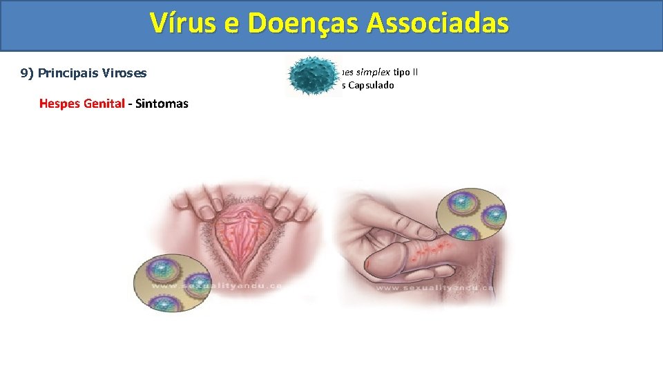 Vírus e Doenças Associadas 9) Principais Viroses Hespes Genital - Sintomas Herpes simplex tipo