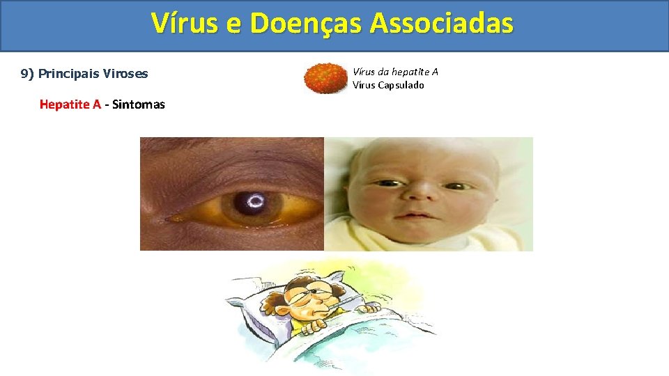 Vírus e Doenças Associadas 9) Principais Viroses Hepatite A - Sintomas Vírus da hepatite