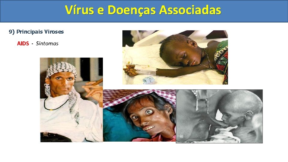 Vírus e Doenças Associadas 9) Principais Viroses AIDS - Sintomas 