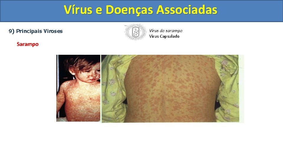 Vírus e Doenças Associadas 9) Principais Viroses Sarampo Vírus do sarampo Vírus Capsulado 