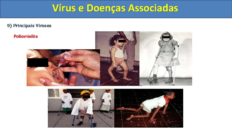 Vírus e Doenças Associadas 9) Principais Viroses Poliomielite 